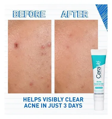 CeraVe Acne Control Gel, image 3